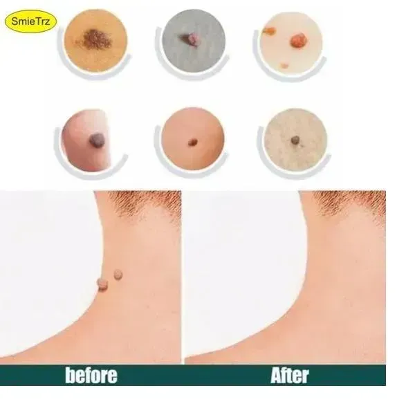 DermaSmooth Skin Tag Remover Patch 72 Pcs Cotton Red