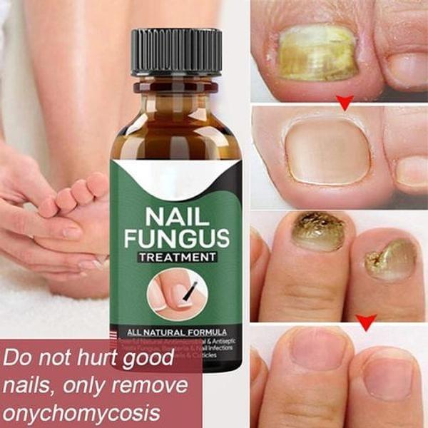 All Natural Nail Fungus Treatment Serum 1pc