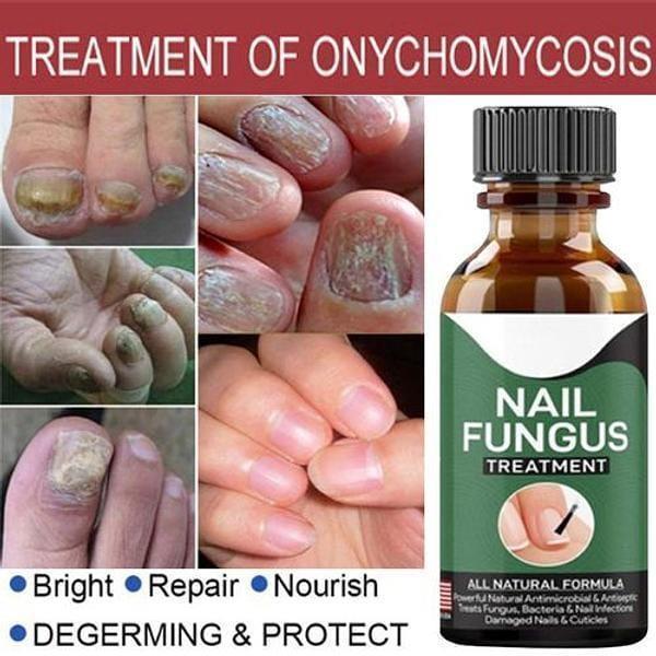 All Natural Nail Fungus Treatment Serum 1pc