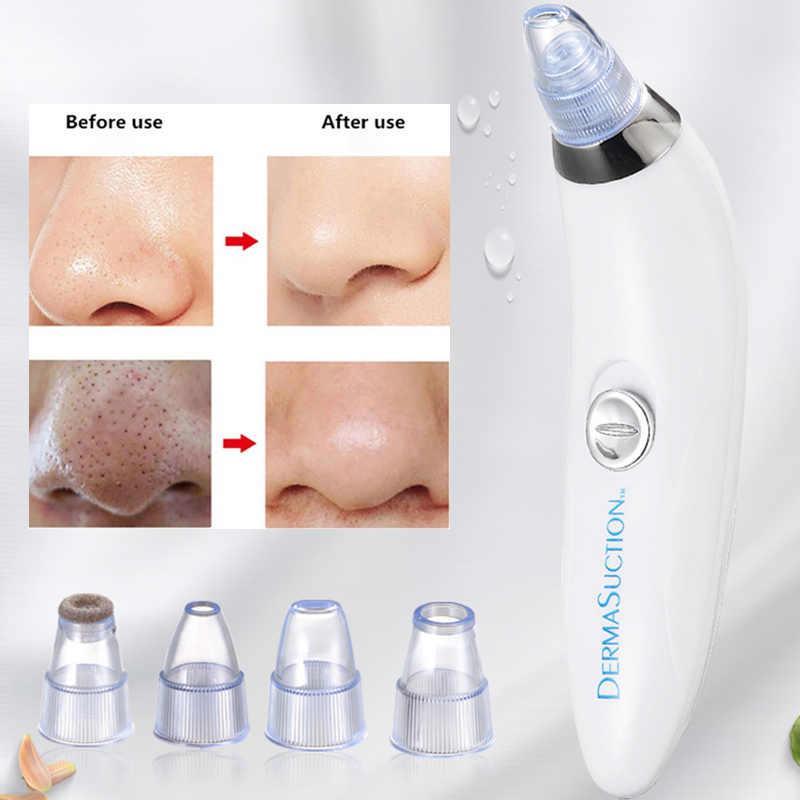 Derma Suction Blackhead Remover for Poreless Skin