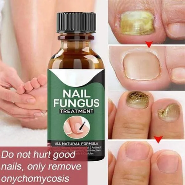 Nail Fungus Treatment Serum