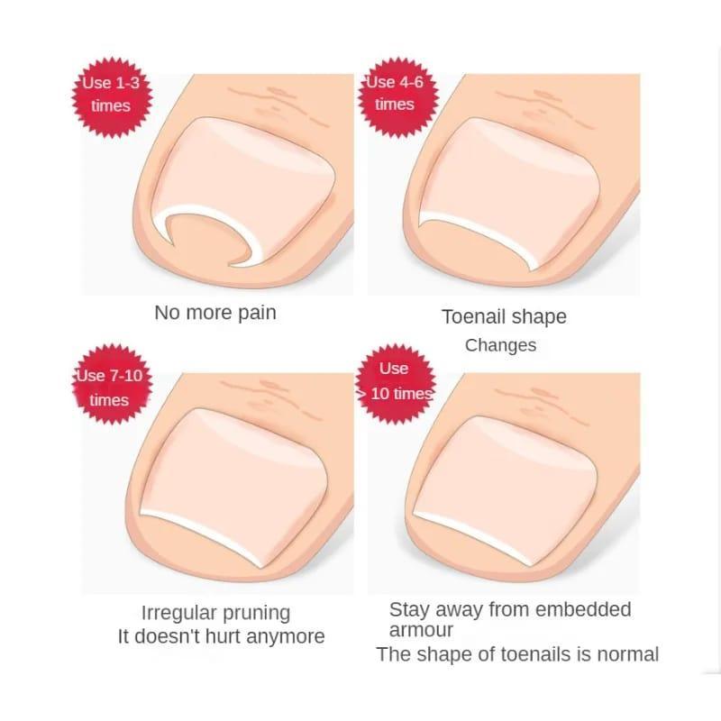Ingrown Nail Correction Tool Golden Metal Travel Size