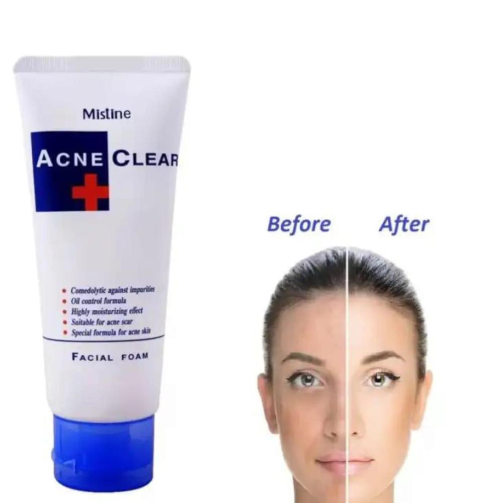 Acne Clear Facial Foam - 85gm
