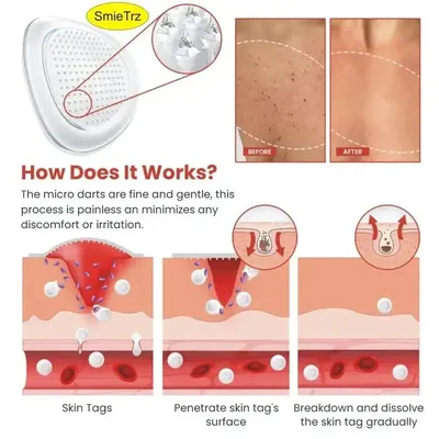DermaSmooth Skin Tag Remover Patch 72 Pcs Cotton Red thumbnail 3