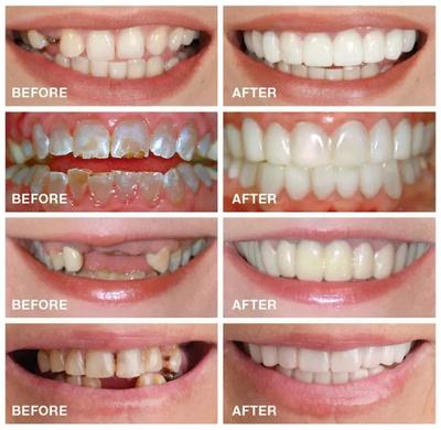 Snap On Fake Teeth Set thumbnail 4